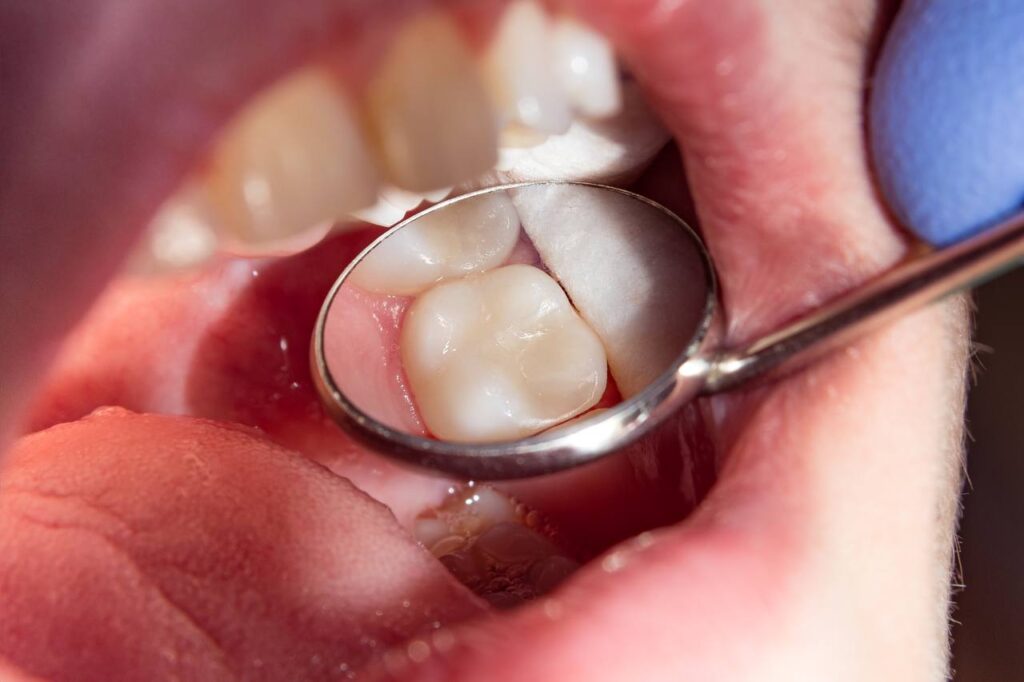Composite Fillings - Dental Clinic Near Me - Dentistry Clinic