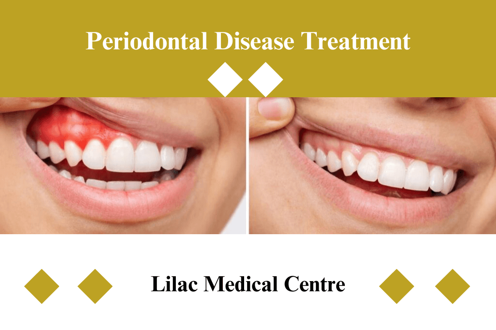 Periodontal Disease Treatment - Dental Clinic in Abu Dhabi